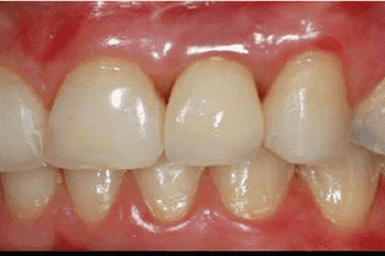 Caso Clínico de implantes dentales después