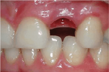 Caso Clínico de implantes dentales antes