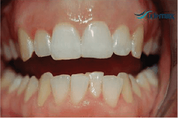 Caso Clínico de reconstrucción dental después