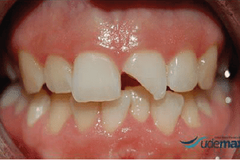 Caso Clínico de reconstrucción dental antes