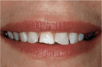 Caso clínico de carillas dentales
